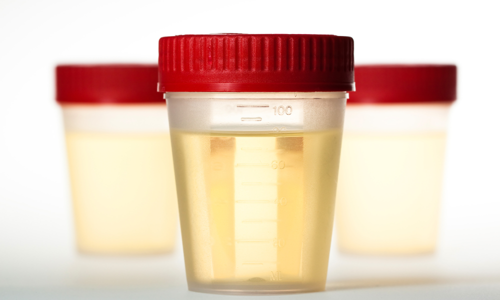 kleurloze urine gezond verschillende oorzaken